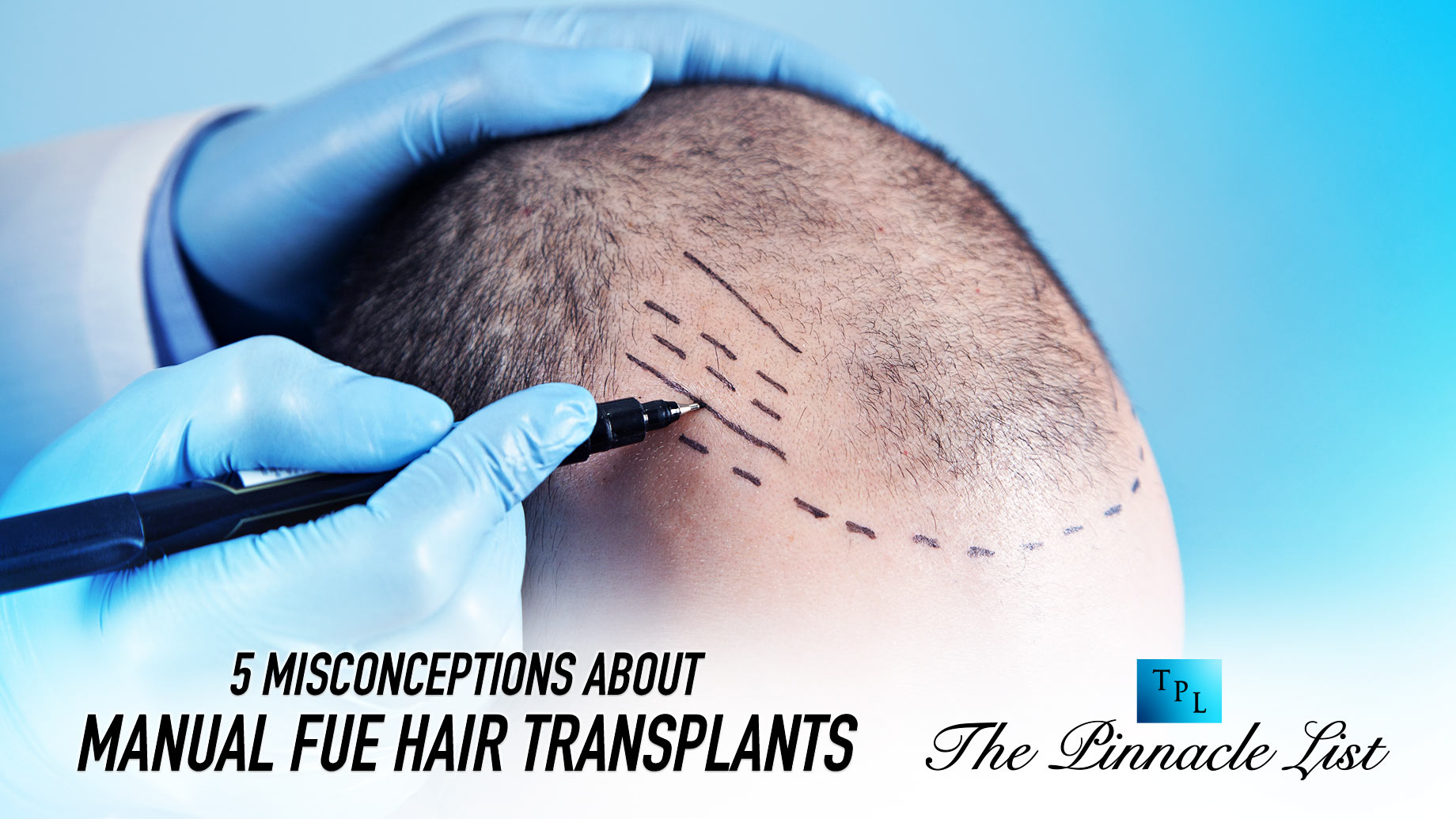 5 Misconceptions About Manual FUE Hair Transplants