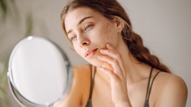 Young Woman with Acne Skin Problems