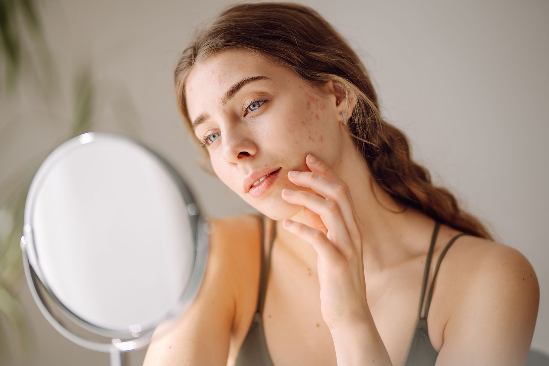 Young Woman with Acne Skin Problems